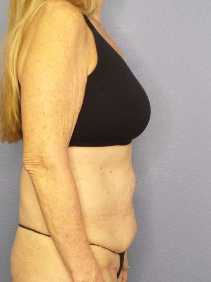 Abdominoplasty Before & After Patient #3610