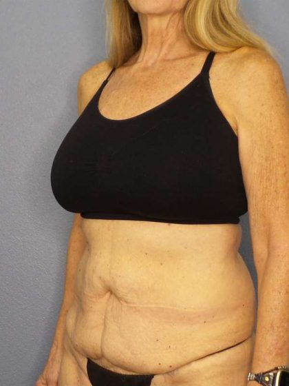 Abdominoplasty Before & After Patient #3610