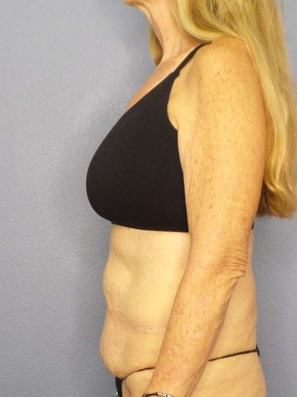 Abdominoplasty Before & After Patient #3610