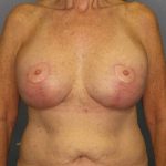 Augmentation Mastopexy Revision Before & After Patient #4617