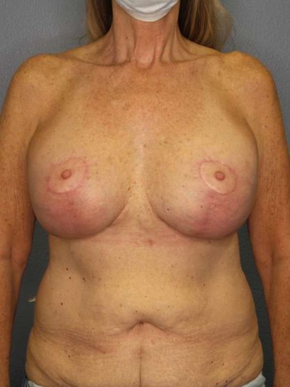 Augmentation Mastopexy Revision Before & After Patient #4617