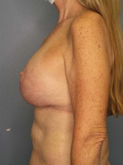 Augmentation Mastopexy Revision Before & After Patient #4617