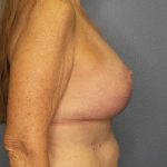 Augmentation Mastopexy Revision Before & After Patient #4617