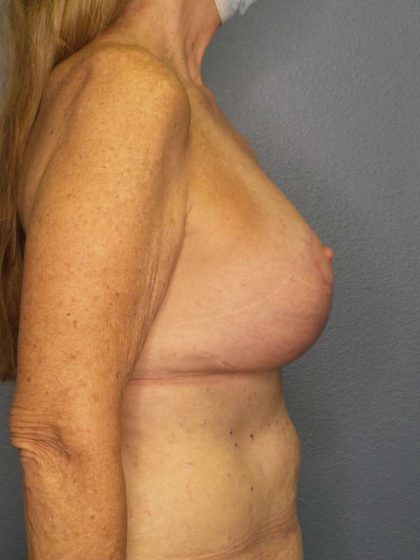 Augmentation Mastopexy Revision Before & After Patient #4617