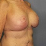 Augmentation Mastopexy Revision Before & After Patient #4617