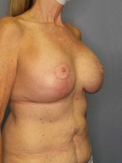 Augmentation Mastopexy Revision Before & After Patient #4617