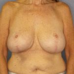Augmentation Mastopexy Revision Before & After Patient #4617