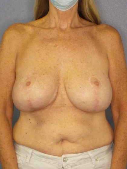 Augmentation Mastopexy Revision Before & After Patient #4617