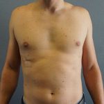 Male Liposuction Before & After Patient #8237