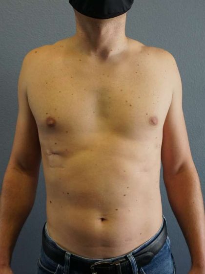 Male Liposuction Before & After Patient #8237