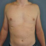 Male Liposuction Before & After Patient #8237