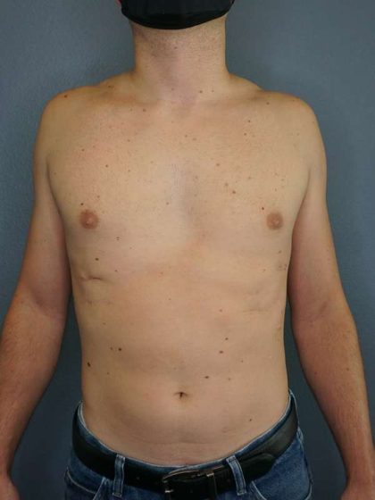 Male Liposuction Before & After Patient #8237