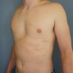Male Liposuction Before & After Patient #8237
