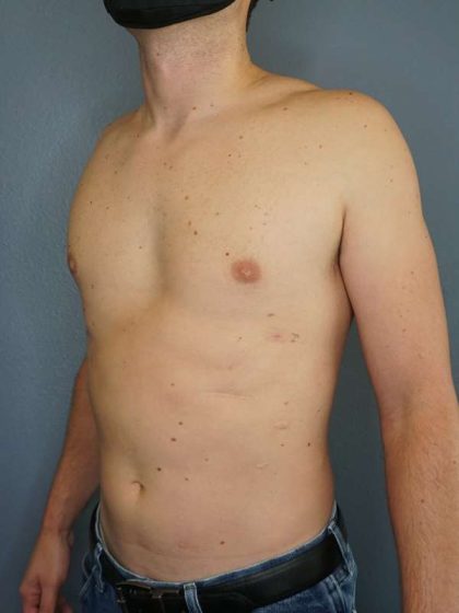 Male Liposuction Before & After Patient #8237