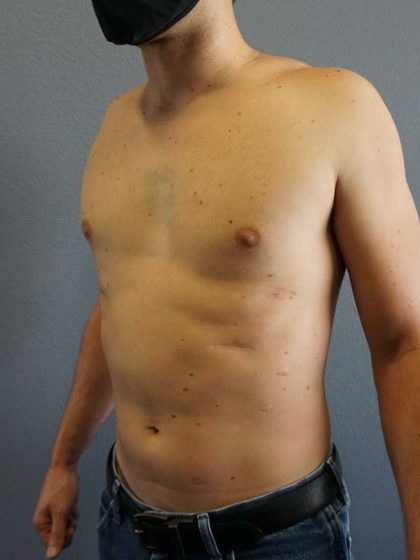 Male Liposuction Before & After Patient #8237