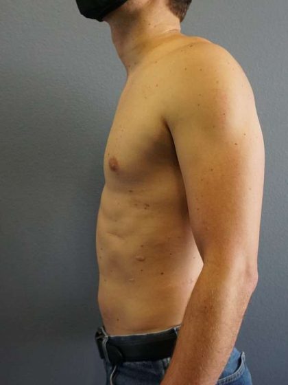 Male Liposuction Before & After Patient #8237