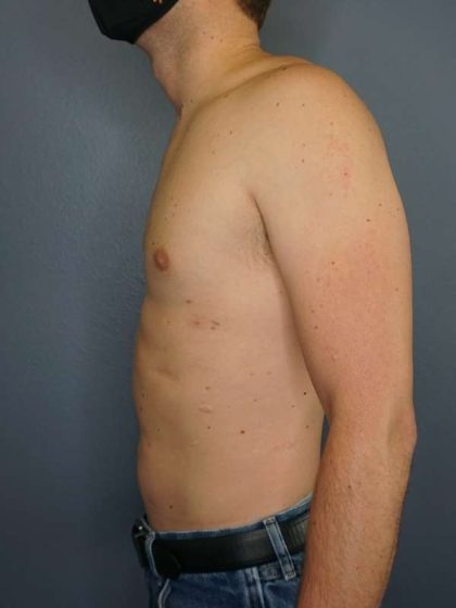 Male Liposuction Before & After Patient #8237