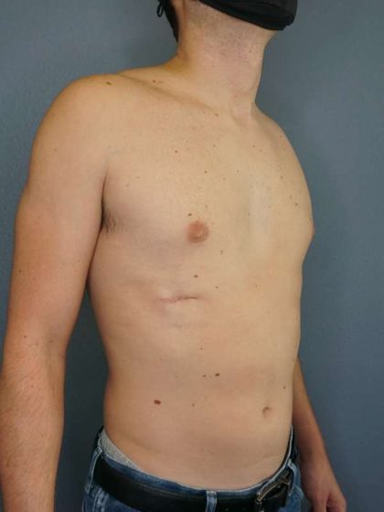 Male Liposuction Before & After Patient #8237