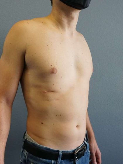 Male Liposuction Before & After Patient #8237