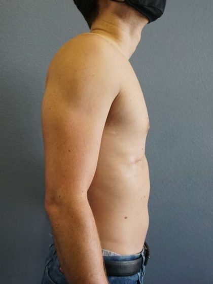 Male Liposuction Before & After Patient #8237