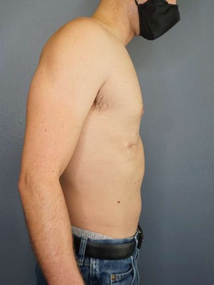 Male Liposuction Before & After Patient #8237
