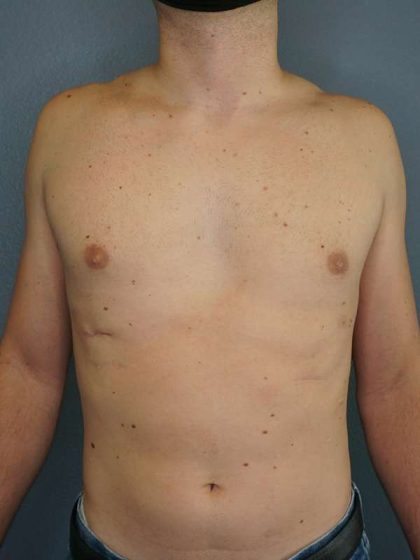 Male Liposuction Before & After Patient #8237