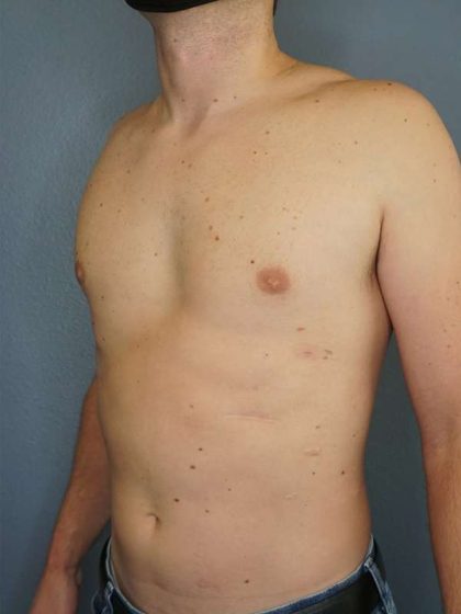 Male Liposuction Before & After Patient #8237