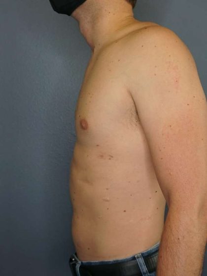 Male Liposuction Before & After Patient #8237