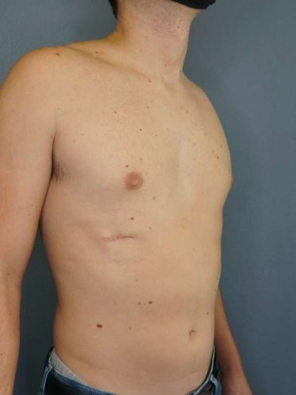 Male Liposuction Before & After Patient #8237