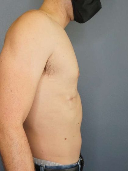 Male Liposuction Before & After Patient #8237