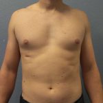 Male Liposuction Before & After Patient #8237