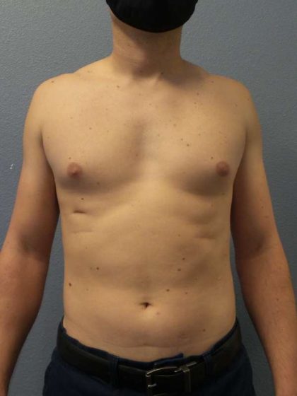 Male Liposuction Before & After Patient #8237