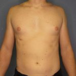 Male Liposuction Before & After Patient #8237