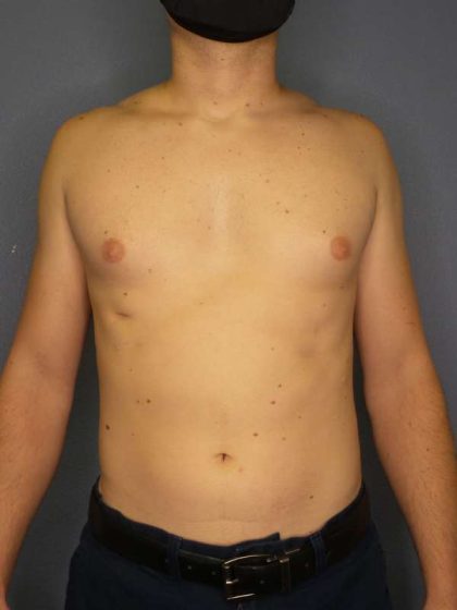 Male Liposuction Before & After Patient #8237