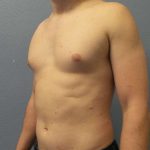 Male Liposuction Before & After Patient #8237