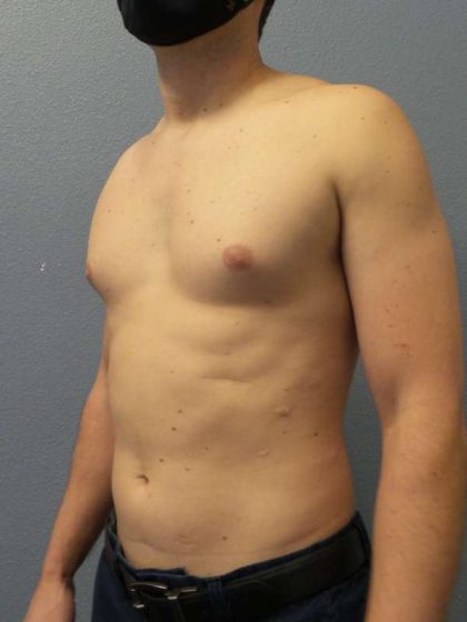 Male Liposuction Before & After Patient #8237