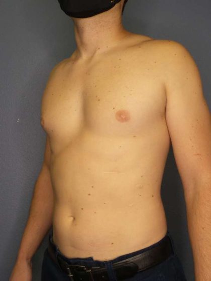 Male Liposuction Before & After Patient #8237