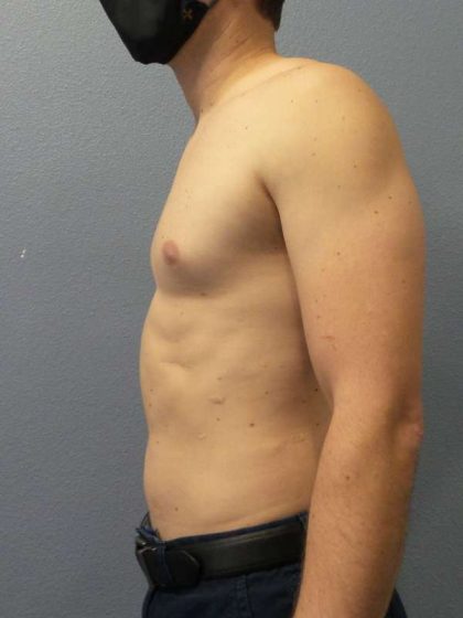 Male Liposuction Before & After Patient #8237