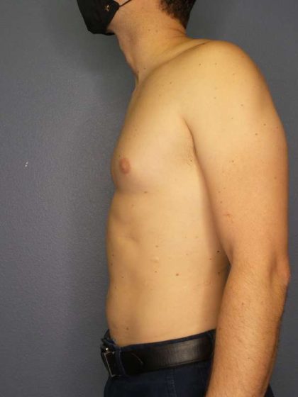 Male Liposuction Before & After Patient #8237