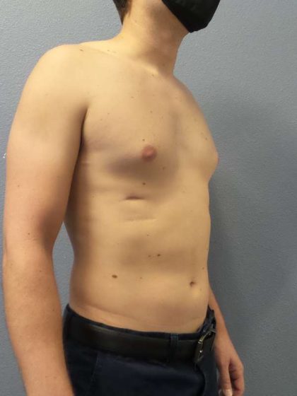 Male Liposuction Before & After Patient #8237