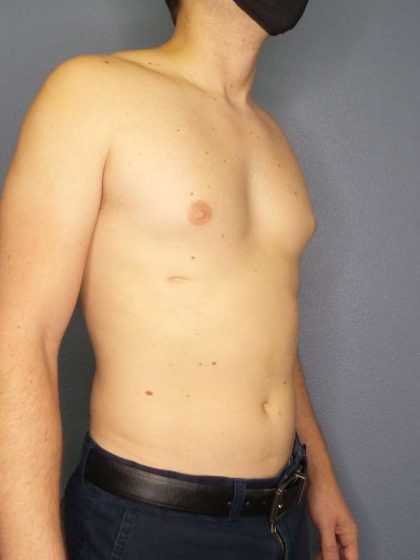 Male Liposuction Before & After Patient #8237