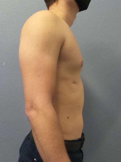 Male Liposuction Before & After Patient #8237