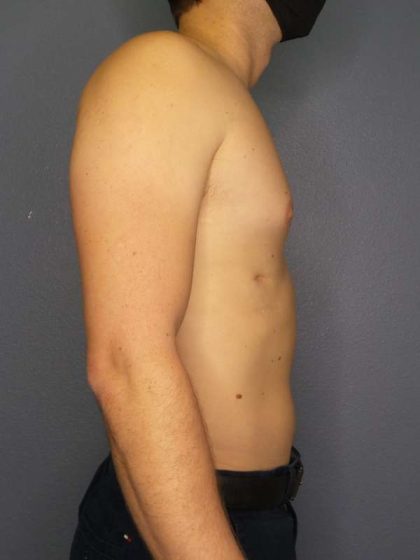 Male Liposuction Before & After Patient #8237