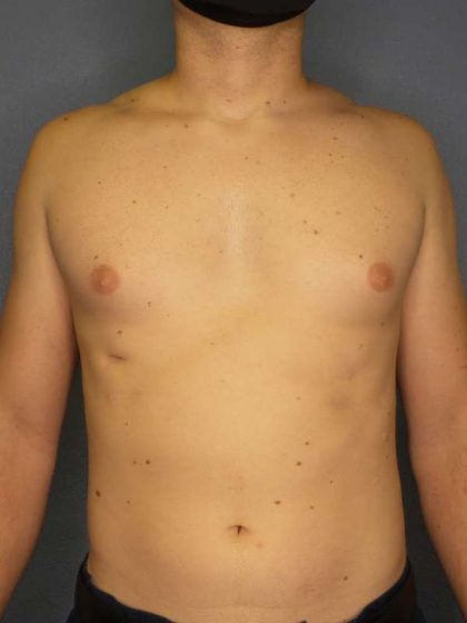 Male Liposuction Before & After Patient #8237
