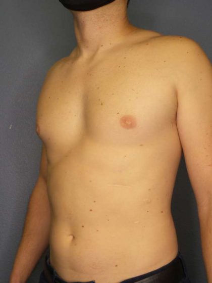 Male Liposuction Before & After Patient #8237