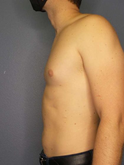 Male Liposuction Before & After Patient #8237