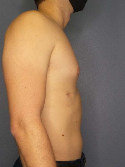 Male Liposuction Before & After Patient #8237