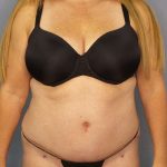 High BMI (Larger Patients) Surgery Before & After Patient #10356