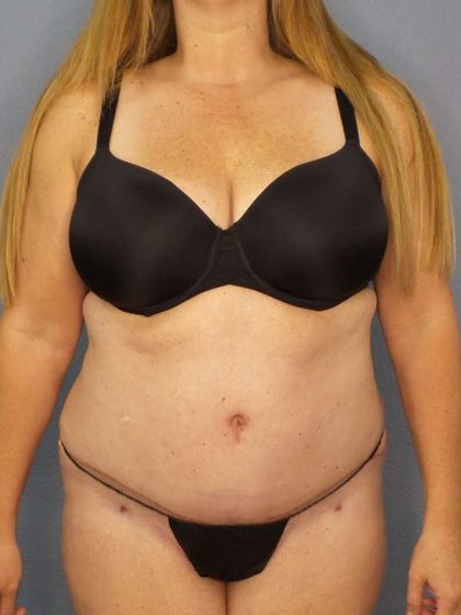 Abdominoplasty Before & After Patient #3366