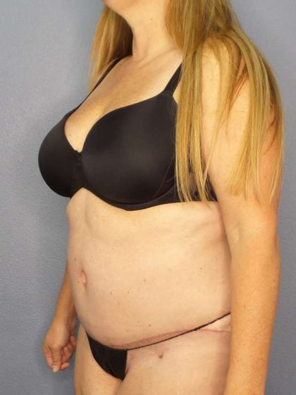 Abdominoplasty Before & After Patient #3366